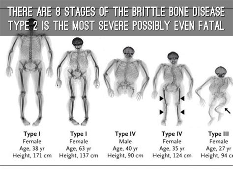 Osteogenesis Imperfecta Type 8