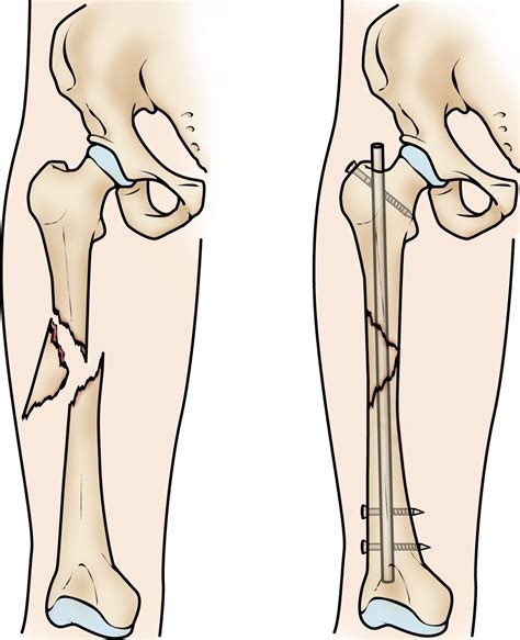 Closed Femur Fracture