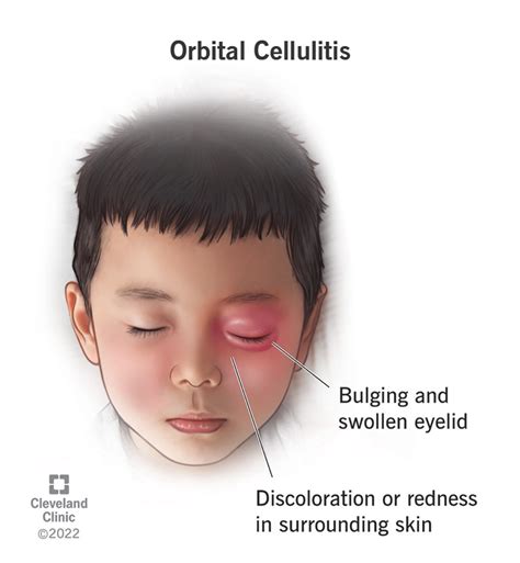 Periorbital Cellulitis Contagious