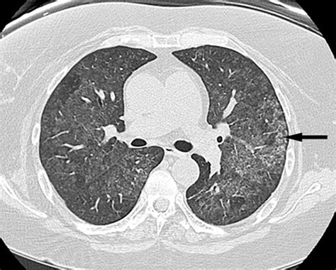 Subpleural Ground Glass Opacity Ct - Glass Designs