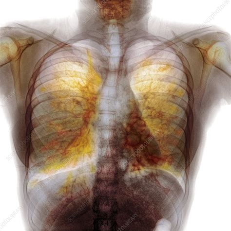 Cystic fibrosis, X-ray - Stock Image - C011/9709 - Science Photo Library