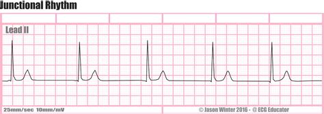 ECG Educator Blog : Six Second ECG Rhythm Strips