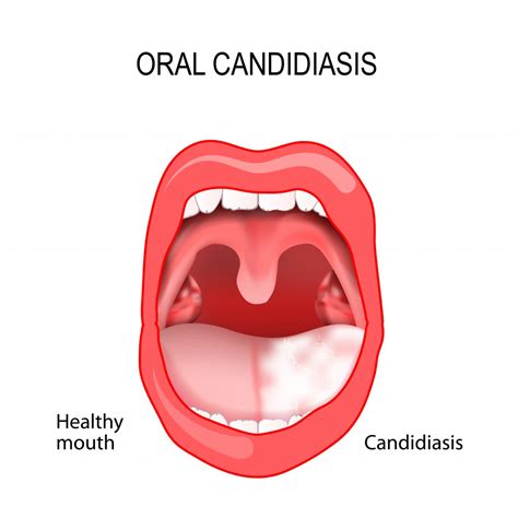 Candidosis symptoms