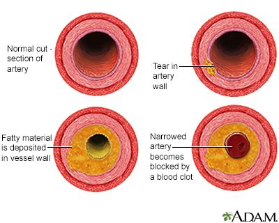 Arterial Insufficiency - Symptoms and Causes