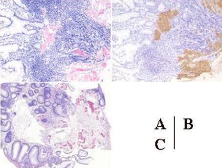 In case 1 histology of the biopsied specimen from the sigmoid colon ...