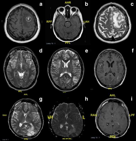 Toxoplasma Gondii Brain Abscess