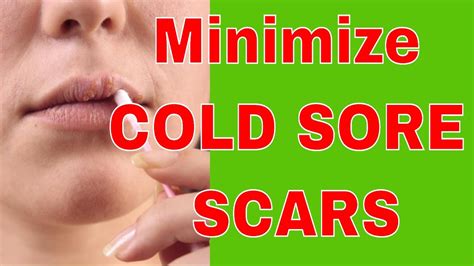 How Can I Minimize COLD SORE SCARS - YouTube