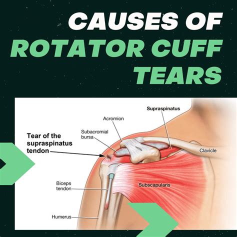 Causes of Rotator Cuff Tears: Ashvin K. Dewan, MD: Orthopedic Surgeon