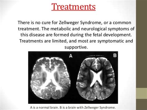 15 best Zellweger Syndrome images on Pinterest | Angel, Angels and Med school