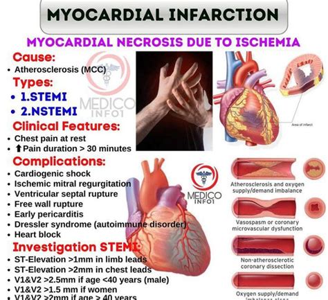 Myocardial Infarction - MEDizzy