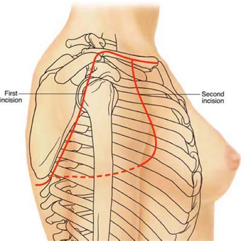 Forequarter Amputation | Plastic Surgery Key