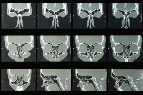 Nasal Polyps Surgery