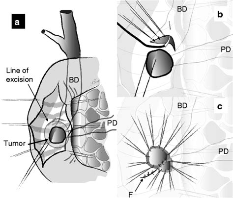 Technical Aspects of Performing Transduodenal Ampullectomy | SpringerLink