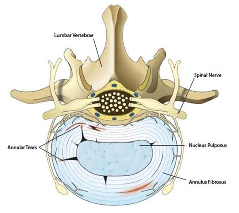 Annular Tear - St. Louis Pain Consultants