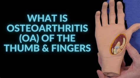 What is Osteoarthritis (OA) of the Thumb & Fingers? - YouTube