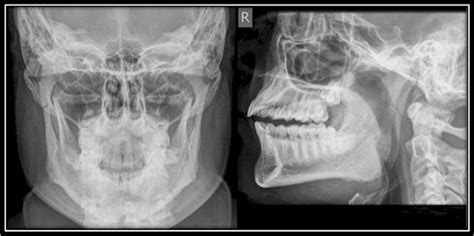 Dislocated Jaw X Ray