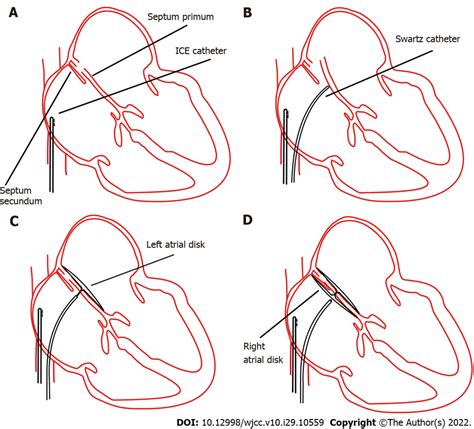 Concept procedures for percutaneous patent foramen ovale closure ...