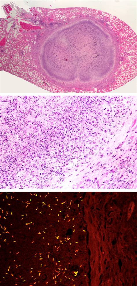 Tuberculosis Lungs Histology