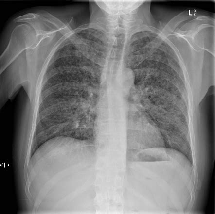 Tuberculosis Lung X Ray