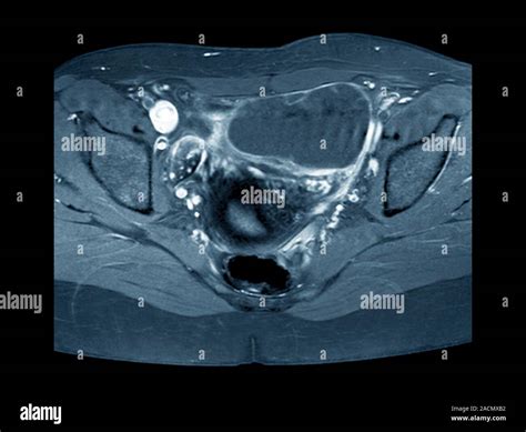 Ovarian cyst. X-ray of a section through the pelvic region of a 29-year-old woman (front of the ...