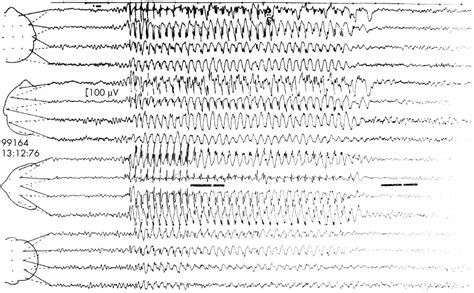 EEG in the diagnosis, classification, and management of patients with ...