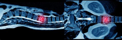 mNGS Diagnoses Spinal Infection Caused by P. micra in Spondylodiscitis of Lumbar - Physician's ...