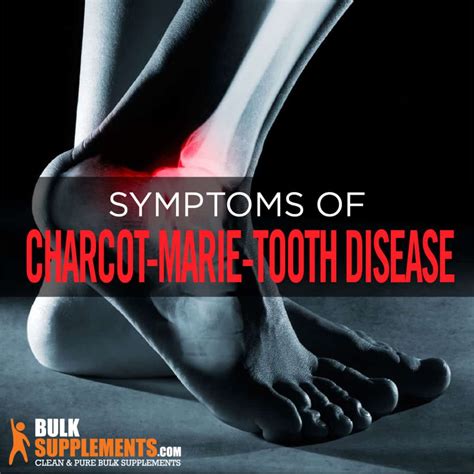 Charcot-Marie-Tooth Disease Symptoms and Treatment