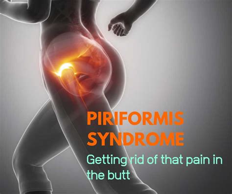 Pain Piriformis Syndrome Symptoms