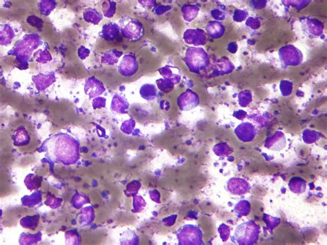 B-cell lymphoma - Wikipedia
