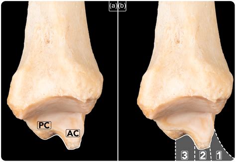 Arthroscopic repair is an effective treatment for dynamic medial ankle instability secondary to ...
