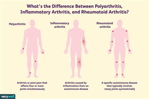 Rheumatoid arthritis stories: What is polyarthritis?