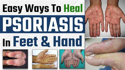 Palmoplantar Psoriasis Symptoms & Treatment | Easy Ways To Heal Psoriasis In Feet & Hand |Dr ...