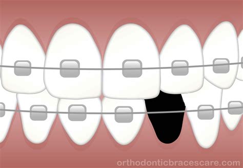 Can Braces Really Close Missing Tooth Gap - Orthodontic Braces Care