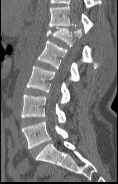 Chance fracture - wikidoc