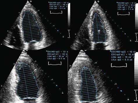 Echocardiogram Congestive Heart Failure - vrogue.co