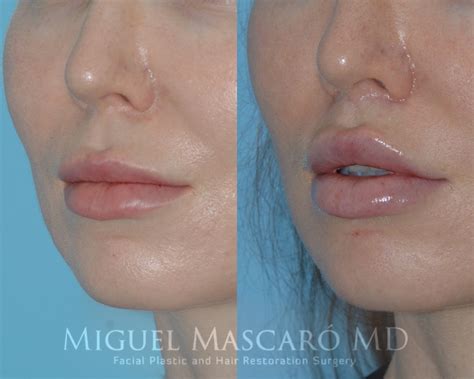 Lip lifts — Miguel Mascaró MD