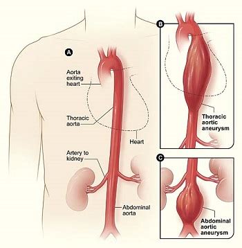 Aortic Aneurysm and Aortic Dissection | BIDMC of Boston