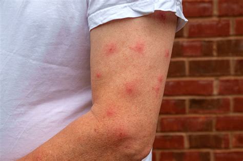 Allergic Reaction To Mosquito Bites Stock Photo - Download Image Now ...