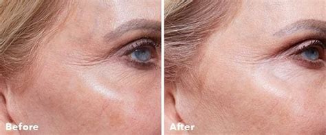 AnteAge Stem Cell Facial - Award Winning Holistic Anti-Aging Treatment Ottawa