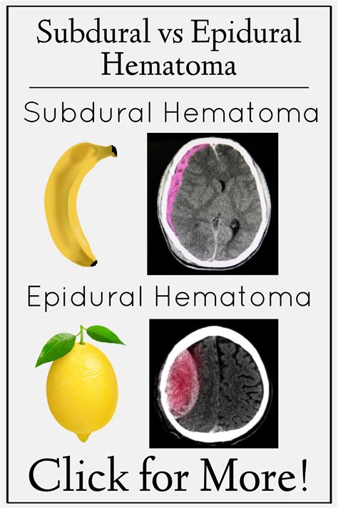 Subdural Vs Epidural Hematoma Symptoms