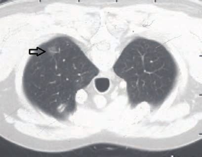 CT scans of chest show the ground-glass nodule in apical segment of the ...