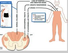 Friedrich's Ataxia | Friedreich's ataxia, Physical therapy, Disorders