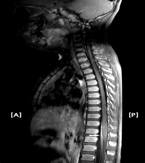 Acute Motor Axonal Neuropathy in a Child With Atypical Prese... : Medicine