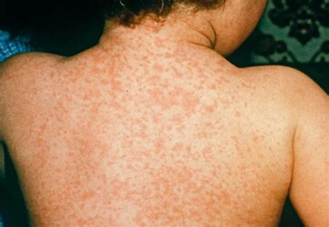 Meningitis Rash - Pictures, Symptoms, Treatment, Causes