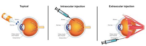 ARL Bio Pharma | Ophthalmic Medication and Particulate Matter