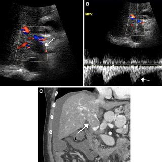 US LI-RADS: ultrasound liver imaging reporting and data system for screening and surveillance of ...