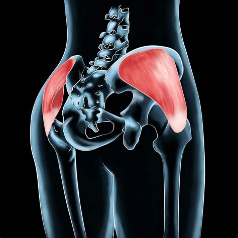 Precision Treatment for Gluteus Medius Injuries