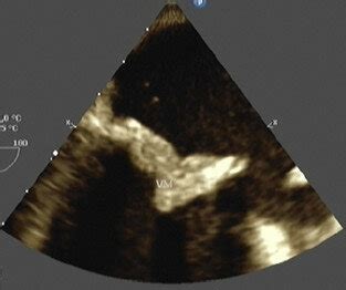 Transesophageal echocardiography showing a diffuse bioprosthetic mitral... | Download Scientific ...