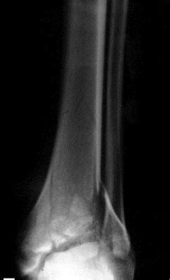 Tibial Plafond Fractures - Trauma - Orthobullets