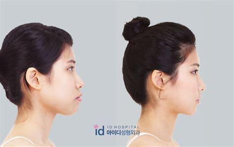 ID Hospital Korea: Mouth protrusion treatment, it is essential to choose treatment method that ...